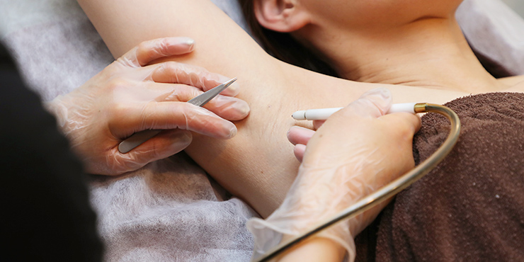 美容電気脱毛について