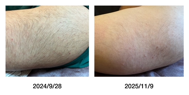 浜松メンズ脱毛