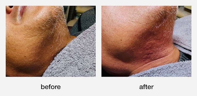 白髪ひげ脱毛　浜松